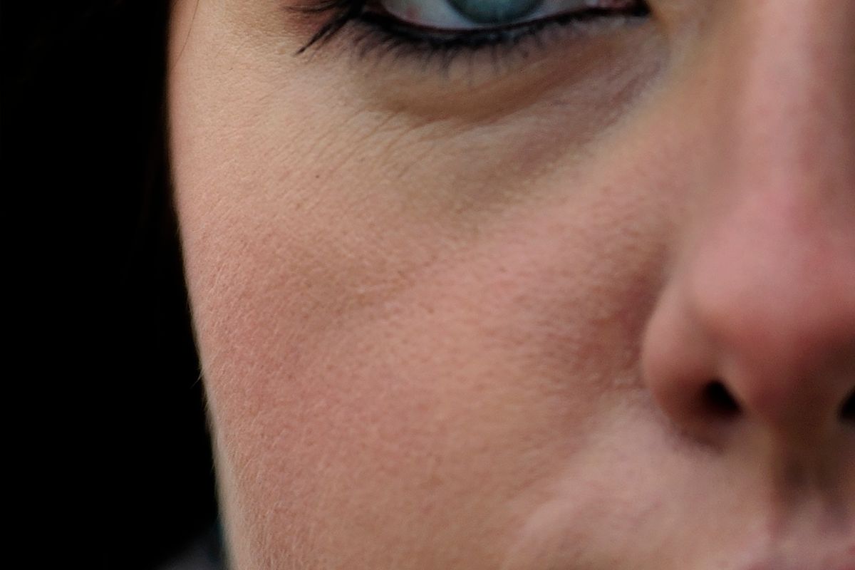 Close-up of small uniform itchy bumps along a jawline